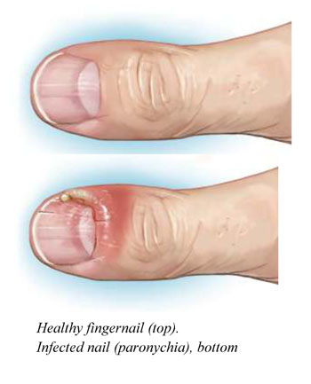 Nail Conditions Treatment at SkinVive in Hyderabad by Dr. Karishni Chittarvu